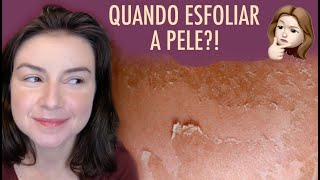 Quando esfoliar a pele  Opinião de Esteticista esfoliacao estetica videobonus [upl. by Lyman]