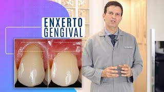 Enxerto gengiva o enxerto para diminuição de gengiva perdida na retração gengival [upl. by Asiram370]