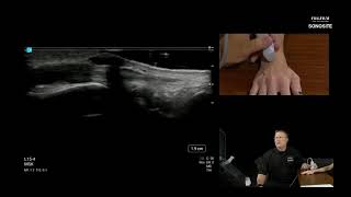 Webinar Ultrasound Evaluation of the Dorsal Wrist [upl. by Kcirdot219]