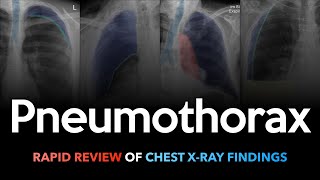 Pneumothorax Rapid Review of Chest Xrays [upl. by Doris994]