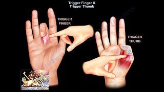 Trigger Finger amp Trigger Thumb  Everything You Need To Know  Dr Nabil Ebraheim [upl. by Necila]