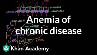 Anemia of chronic disease  Hematologic System Diseases  NCLEXRN  Khan Academy [upl. by Tertius]