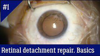 The general principles of vitrectomy for retinal detachment repair [upl. by Aneles]