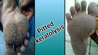 Pitted Keratolysis [upl. by Khano]