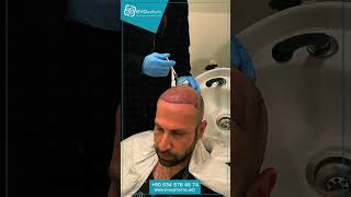 Hair Transplant Experience in Turkey [upl. by Ahsilram]