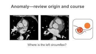 Describing coronary artery anomalies [upl. by Gladine530]