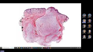 GYN soft tissue tumor pathology [upl. by Mathilde578]