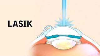 LASIK Surgery and its Risks [upl. by Akeihsat]