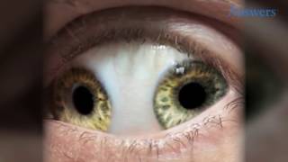 Rare Eye Conditions You Have To See To Believe [upl. by Clari410]