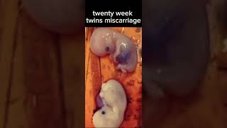 Twenty weeks twins miscarriage shortsviral viralvideo twins babies [upl. by Kisung]