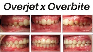 Overjet x Overbite  explicação [upl. by Carolus]