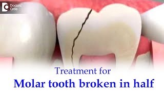 Back toothMolar tooth broke in half inside What to do  Dr Ranjani Rao  Doctors Circle [upl. by Enneillij]