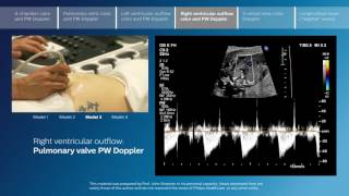 Part 4  Right ventricular outflow color and PW Doppler [upl. by Ephram381]