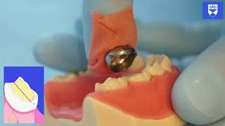 Stainless Steel Crown Technique for a Primary Molar Tooth [upl. by Aloibaf]