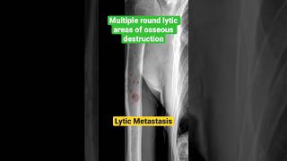 Lytic metastasis from lung cancer 🫁radiology radiologyfundamentals metastasis [upl. by Siramed370]