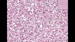 Histopathology LiverFatty change [upl. by Anele910]