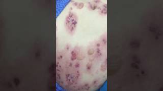 Demonstration of Bulla spreading sign in pemphigus [upl. by Marilyn]