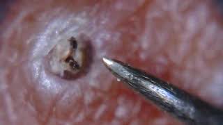 Itchy ingrown hair removed [upl. by Llewen211]