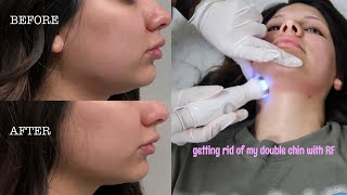 Getting rid of my double chin with radio frequency skin tightening it worked before amp after [upl. by Analram]