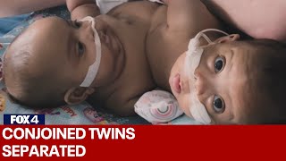 Conjoined twins separated at Cook Childrens Medical Center [upl. by Masson3]