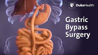 Gastric Bypass Surgery  Duke Health [upl. by Derron20]