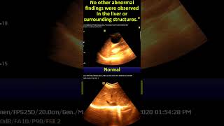 Ultrasonography of Liver Cyst Sonographic Report amp Interpretation [upl. by Renick]