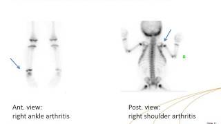 IAEAESNM Webinar  Paediatric Non Oncologic Bone Scintigraphy [upl. by Rosena429]