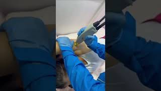 Depilación LASER en AXILAS Proceso  Laser Candela Ndya [upl. by Adnohsor]