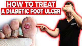 How to Treat a Diabetic Foot Ulcer Early Signs Causes amp Treatment [upl. by Celisse]