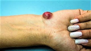 How To Get Rid Of Ganglion Cysts [upl. by Nyleak]