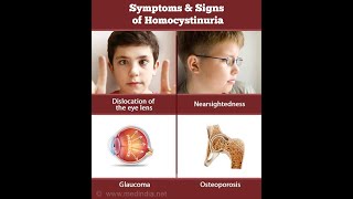 Homocystinuria Cuases Diagnosis and Treatment [upl. by Gerlac573]