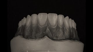 Escultura Gingival y Festoneado en Prostodoncia Total Superior [upl. by Inerney]