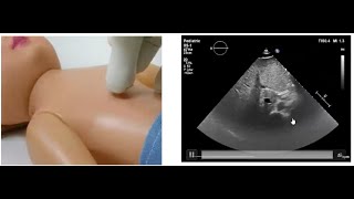 Basics of Pediatric Echocardiography Determining the Situs by Dr Gaurav Agrawal [upl. by Sinclair]