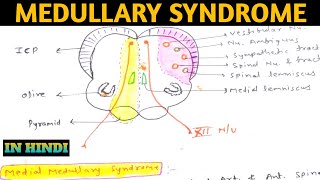 Medullary Syndrome  Medial Medullary Syndrome  Lateral Medullary Syndrome  Wallenberg Syndrome [upl. by Cone]