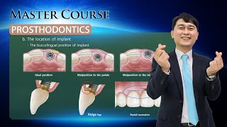 Master Course  PROSTHODONTICS Diagnosis and Tx planning for Anterior esthetic implant Prosthesis [upl. by Daley]