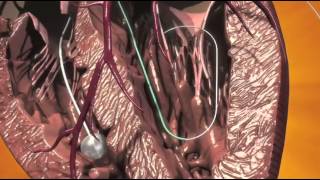 CoreValve Animation Full Procedure [upl. by Rego]