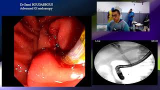 ERCP with SEMS [upl. by Odranreb]