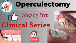 Operculectomy  Step by Step  Clinical Series [upl. by Aneled]