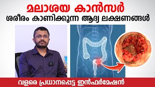 മലാശയ കാൻസർ ശരീരം കാണിക്കുന്ന ആദ്യ ലക്ഷണങ്ങൾ  Colon cancer Malayalam  Dr Shabeer Ali  KIMS HEALTH [upl. by Droffats]