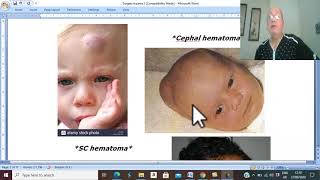 Trauma in Arabic 7 Scalp Haematoma  by Dr Wahdan [upl. by Yroc]