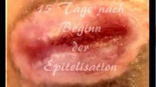 Wundheilung mit VAC Therapiesystem der Firma KCIwmv [upl. by Cynthie]