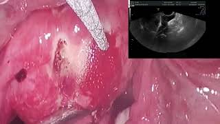 LUMWAlap and usg guided microwave ablation for uterine adenomyosis [upl. by Harhay]