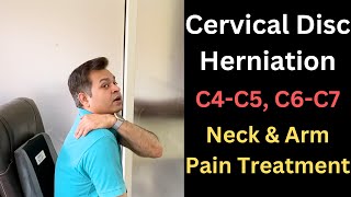 Cervical Disc Herniation C5C6 Neck and Arm Pain Cervical Symptoms Cervical Radiculopathy [upl. by Orbadiah829]