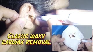 Classic Waxy Earwax Removal [upl. by Nuahsor111]