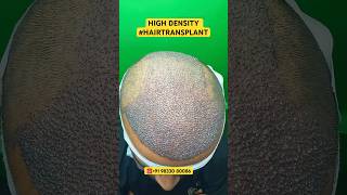 Hair Loss Treatment hair hairloss hairlosstreatment ytshorts alopecia hairtransplant hairfall [upl. by Kcered]