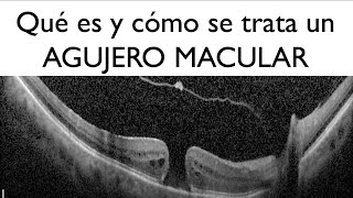 ¿Qué es y cómo se trata un agujero macular  Dr Gerardo García Aguirre  Retina [upl. by Sperry]