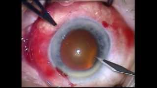 Paracentesis Cataract Surgery [upl. by Claiborne107]