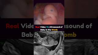 Real Video Vs Ultrasound of a Baby in the Womb 🤩 pregnancy real fetus [upl. by Farrell]