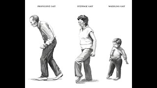 Waddling Gait Myopathic Gait  Definition Causes characteristics Disease association Diagnosis [upl. by Weaks]