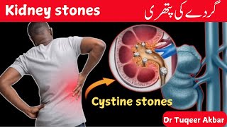 Kidney stones Renal calculus Nephrolithiasis  Cystine stones  Symptoms  Causes  By Dr Tuqeer [upl. by Eiznik859]